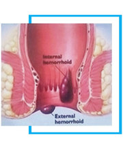 Best treatment for piles – Haemorrhoidectomy in  NewDelhi,  India